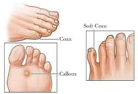 Examples of Corns and Callouses