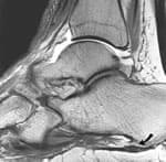 Plantar Fasciitis MRI