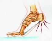 Plantar Fasciitis