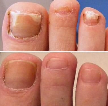 Toe health improvement