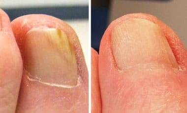 Treated toe example