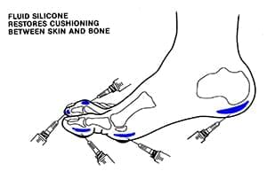 Fluid Silicone Implantation Treatment - Foot and Ankle Wellness Clinic